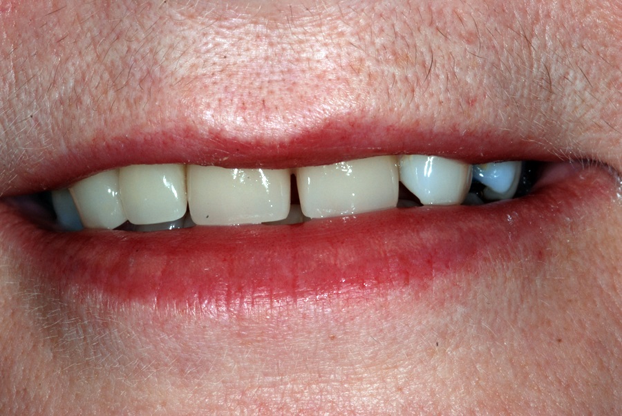 Case 1 After